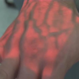 Blutabnahme: Mini-Gerät macht Venen sichtbar